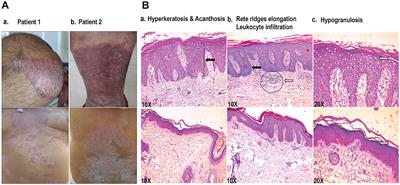 A panel of blood-based circulatory miRNAs with diagnostic potential in patients with psoriasis